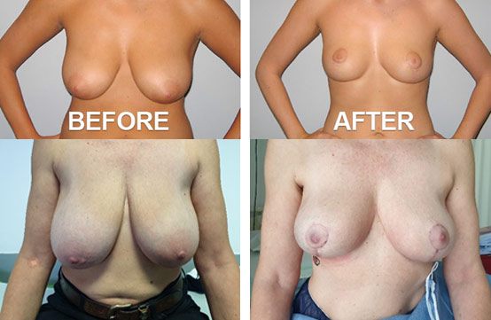 Προηγμένη Ογκοπλαστική Χειρουργική Μαστού – Μαστοπλαστική Εικόνα Πριν και μετά