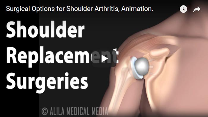 Surgical Options for Shoulder Arthritis, Animation