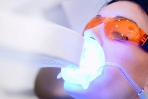 Λεύκανση δοντιών στο Ιατρείο: Power Bleaching